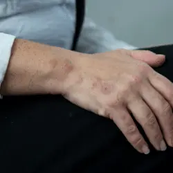 Imagen de picadura de chinches