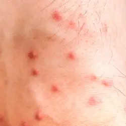 Imagen de picadura de Pulgas